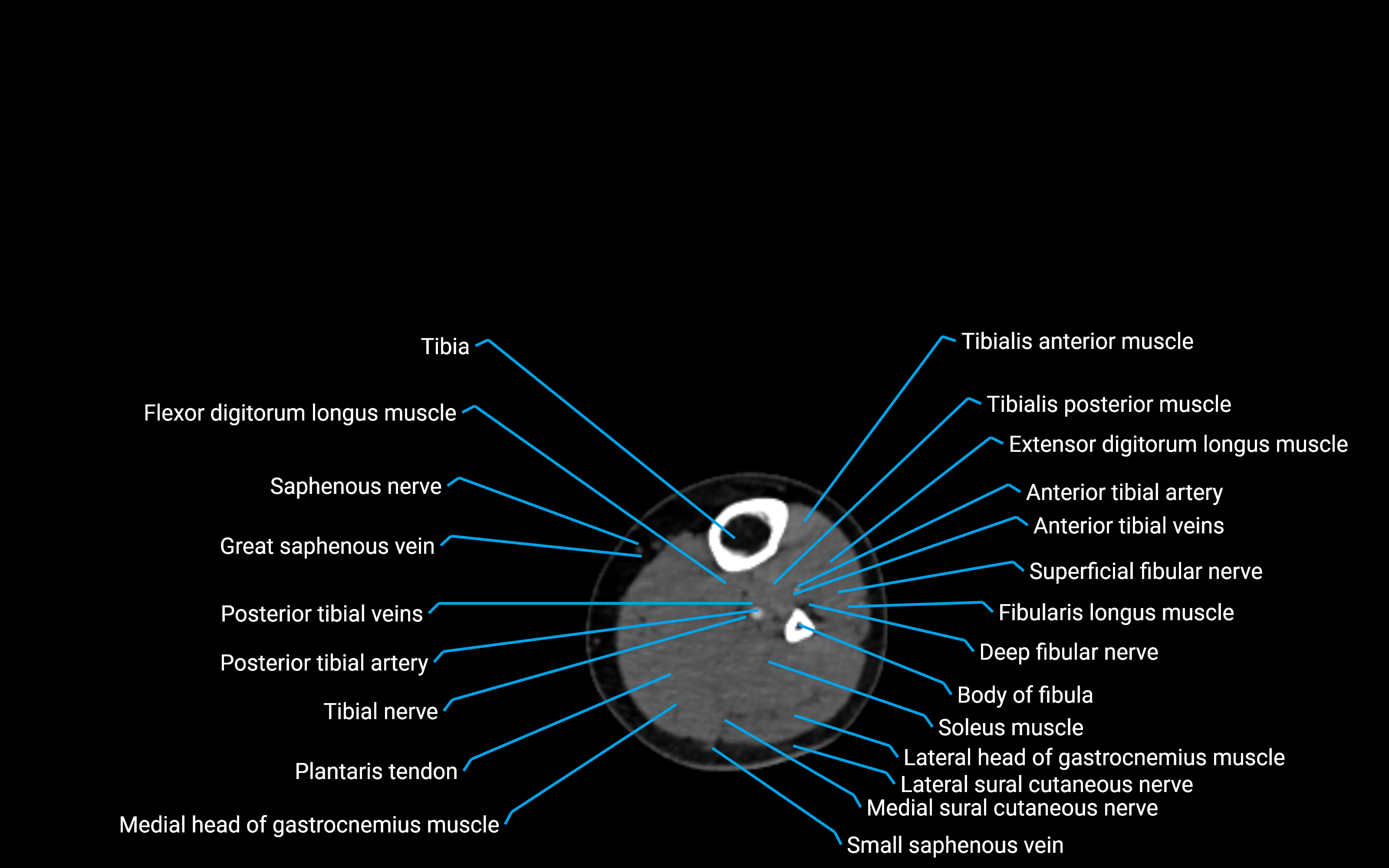 CT Lower leg axial cross sectional anatomy labelled image 108 (2).png